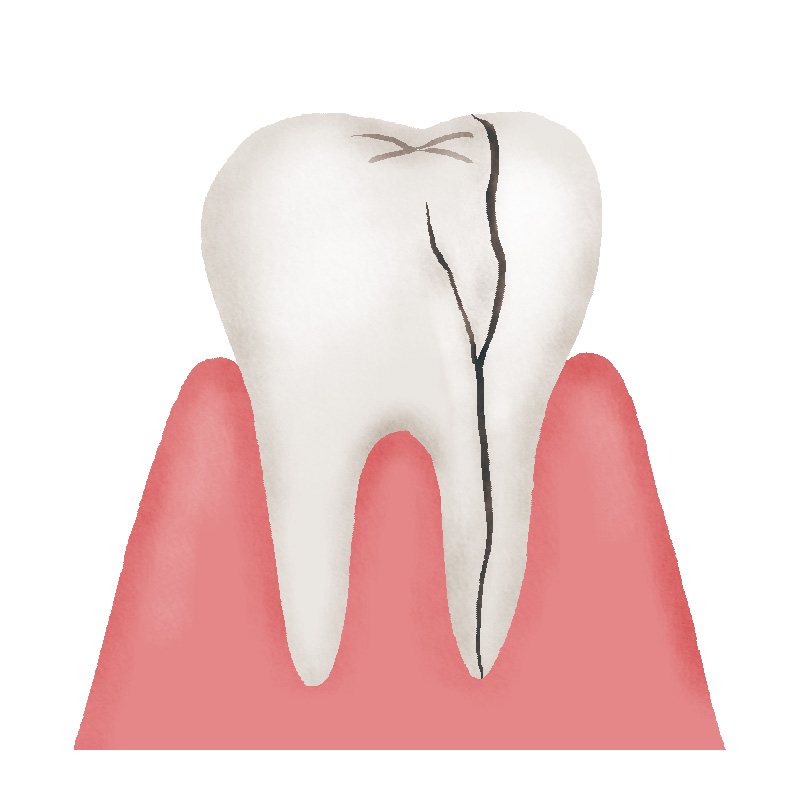 歯の破折について（歯根破折）